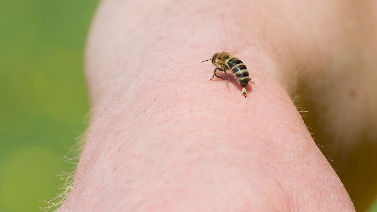 Hausmittel gegen Insektenstiche / ein Mensch wird von einer Honigbiene gestochen 